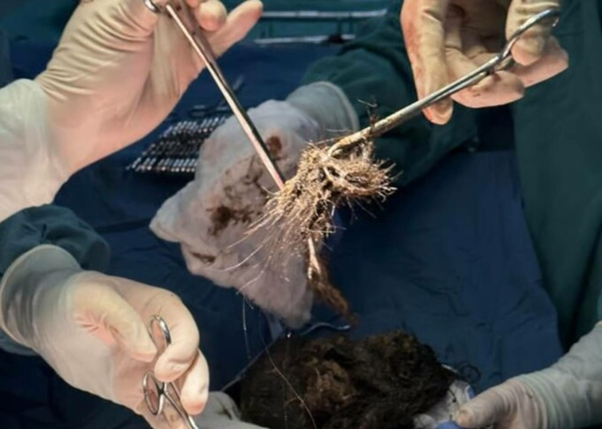 Ce au găsit medicii în stomacul unei adolescente! Aceasta avea un obicei ciudat ce a dus-o aproape de moarte!