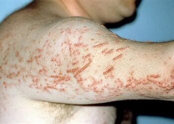 Alertă medicală! Un caz de lepră confirmat la un salon SPA. Activitatea unității, suspendată. Alte trei cazuri sunt investigate!