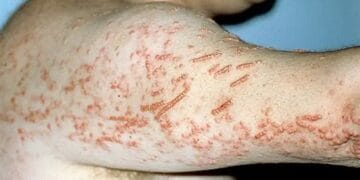 Alertă medicală! Un caz de lepră confirmat la un salon SPA. Activitatea unității, suspendată. Alte trei cazuri sunt investigate!